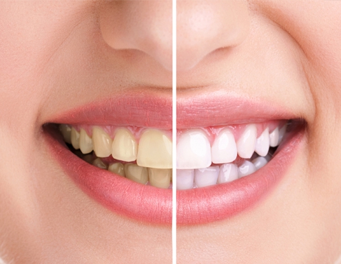 Teeth Whitening Options for a beautiful smile
