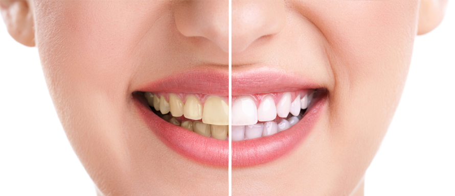 Teeth Whitening Options for a beautiful smile